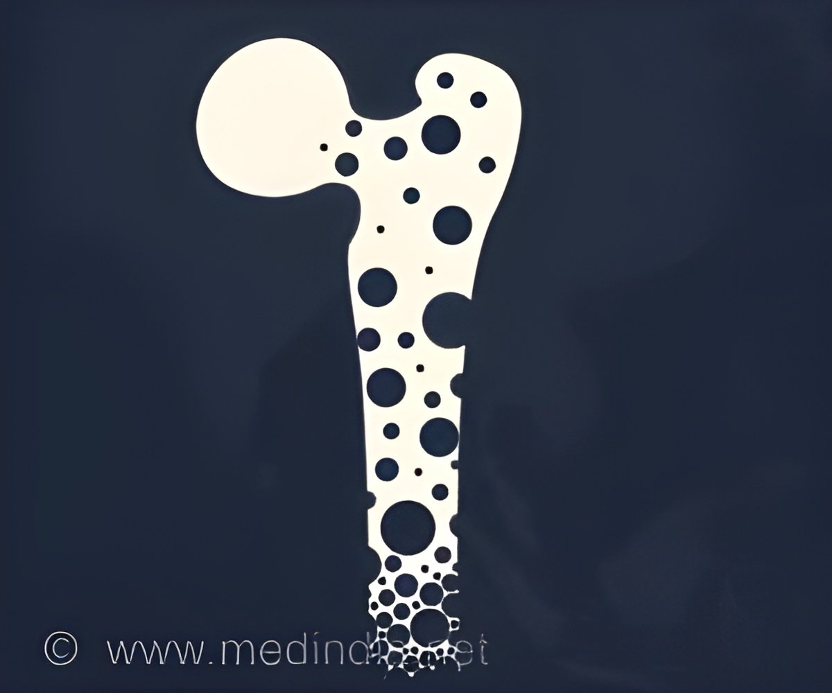 AI's Role in Detecting Osteoporosis Revealed