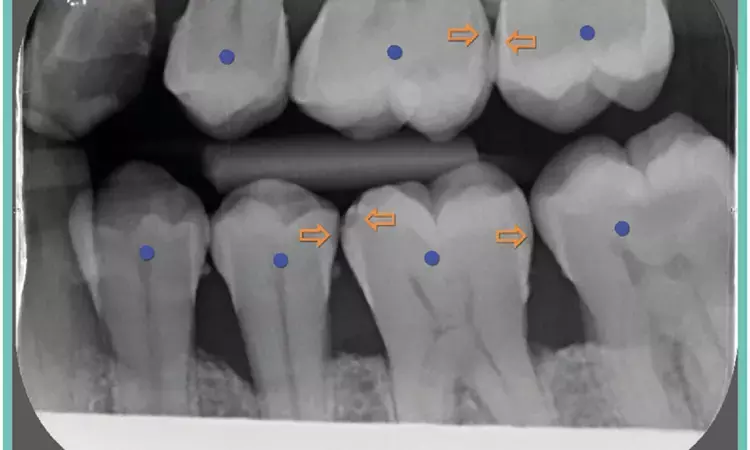 AI systems promising for diagnosis of dental caries on intraoral radiographs: Study