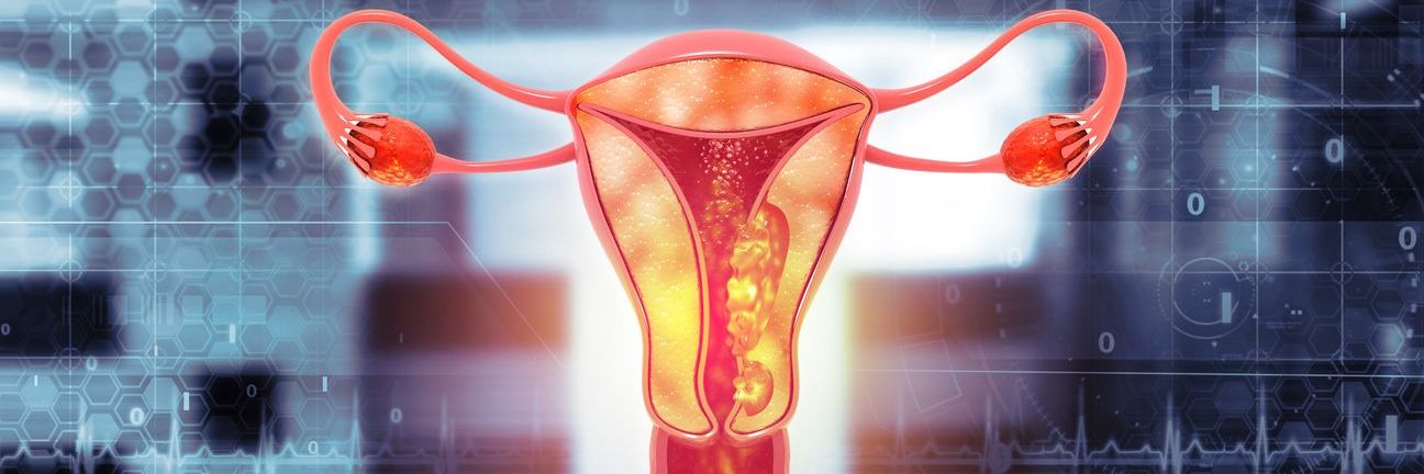 Predicting Endometrial Cancer Recurrence With a Deep Learning Model