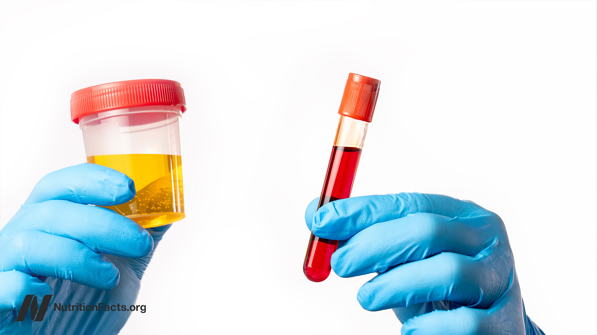 Testing for Vitamin B12 Deficiency