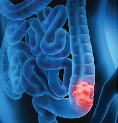 Colorectal Cancer Prevention and Treatment