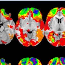 We Now Know Where PTSD Lives in the Brain