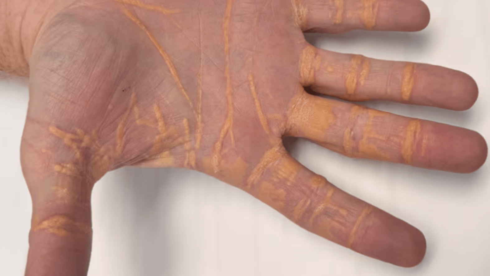 Man on carnivore diet has cholesterol of 1,000, sees shocking symptom on his hands